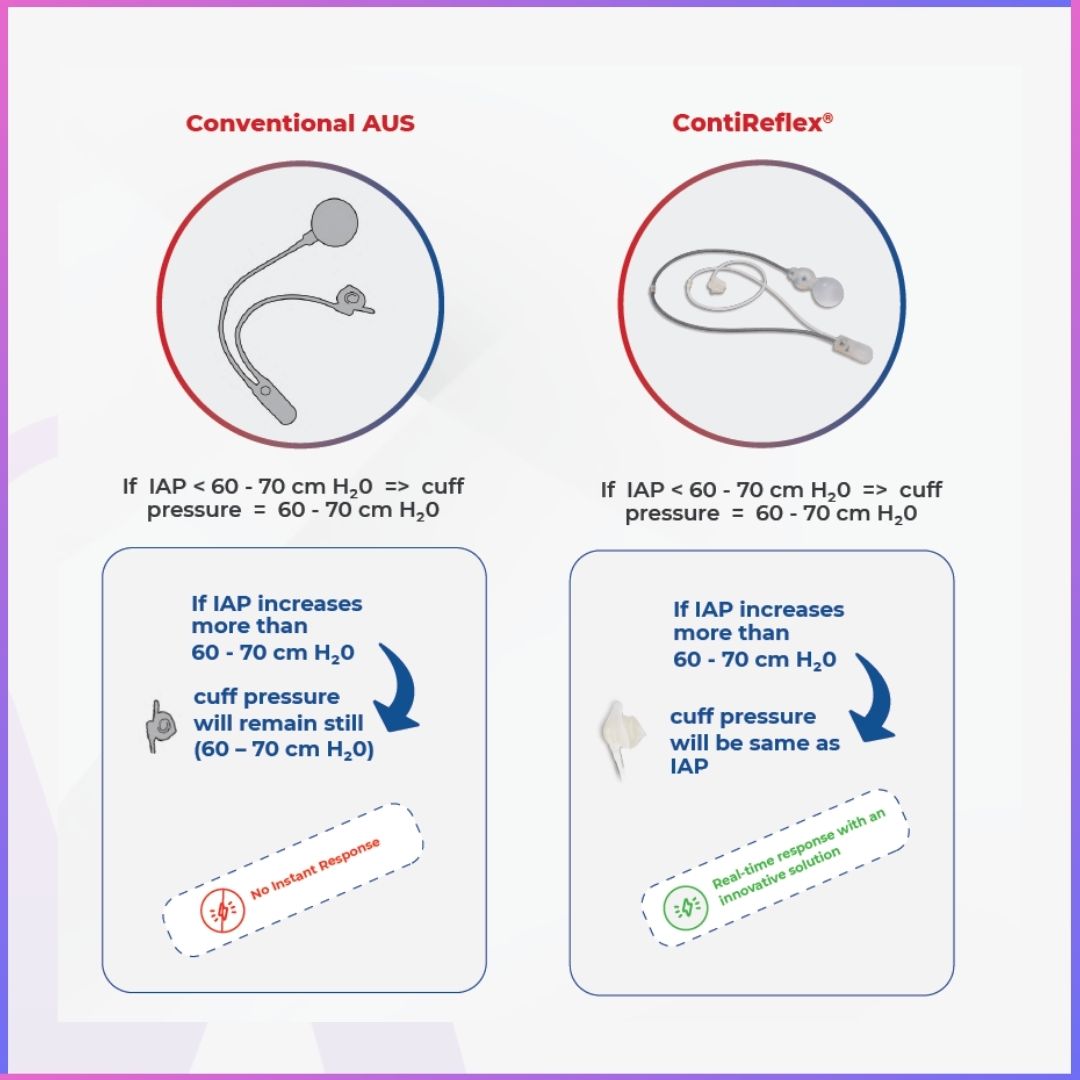 ContiReflex® Enhanced Artificial Urinary Sphincter